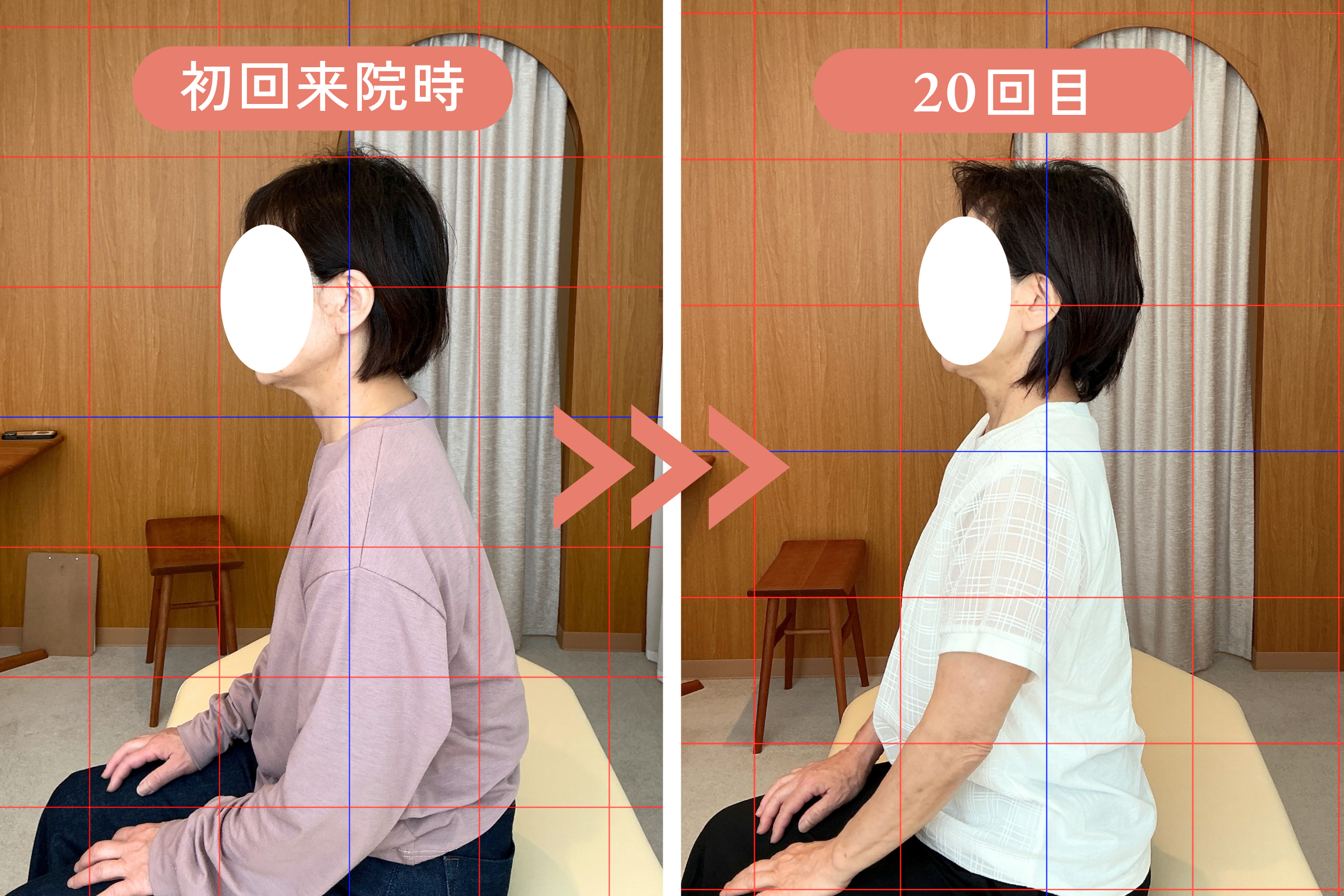 M様 20回継続施術のビフォーアフター｜姿勢と呼吸の変化