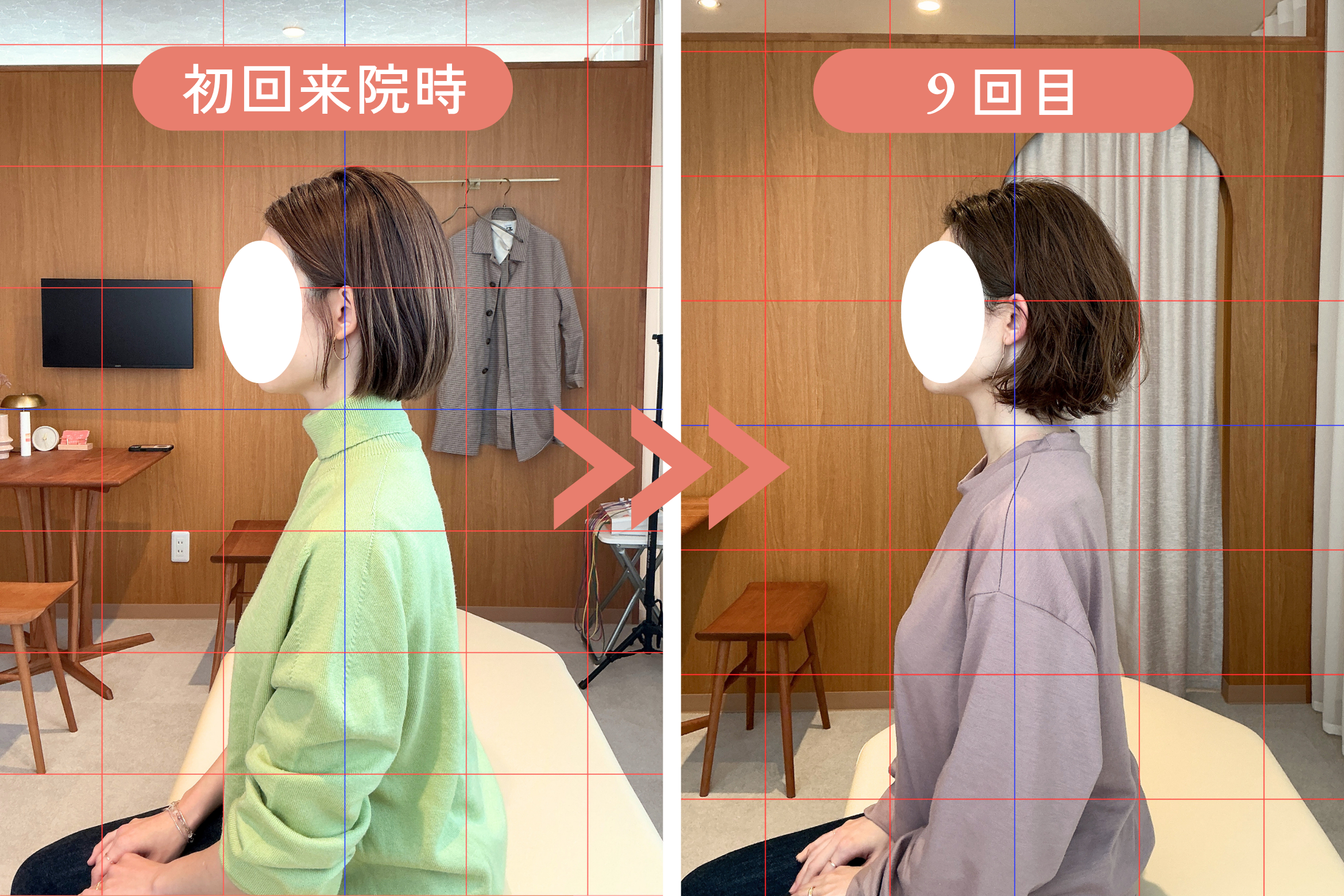 U様 継続施術のビフォーアフター｜首・肩の状態と姿勢の変化