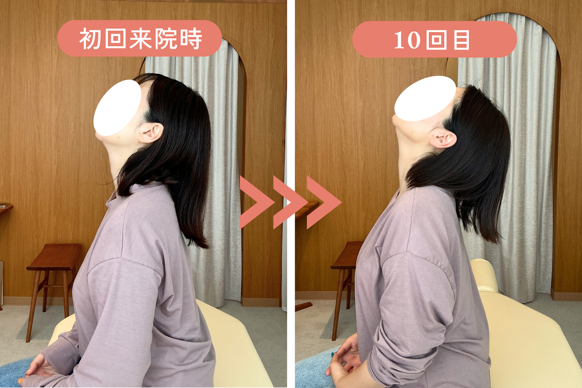首の可動域 前後比較。初回来院時と10回目で、後屈の角度が明らかに改善している。U様（リリーフポートフェミナ鍼灸整体院 大濠公園店）