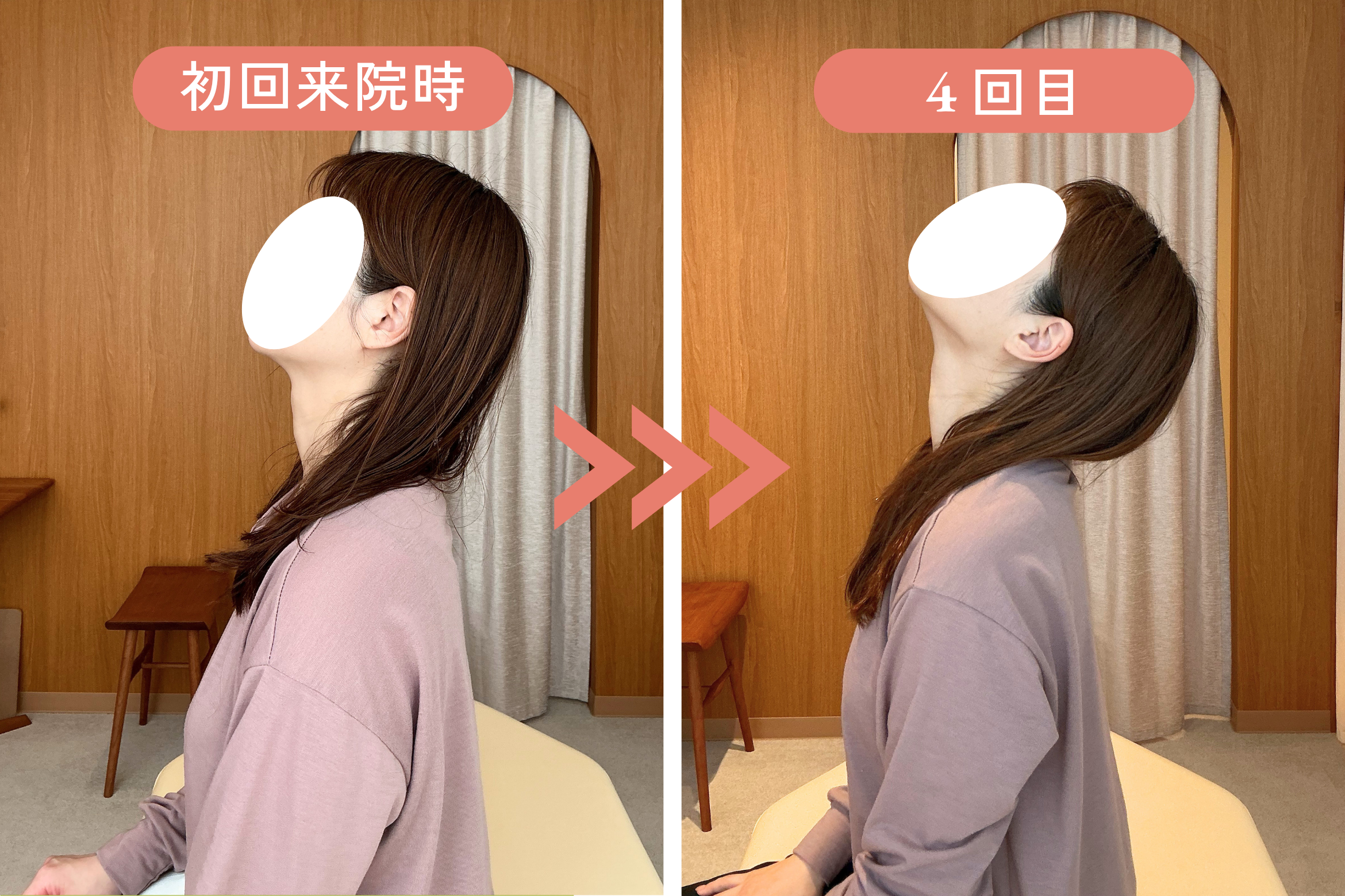W様 初回来院時と4回目の比較。首肩の力みが取れ、肩の高さ・首の角度が整っている様子