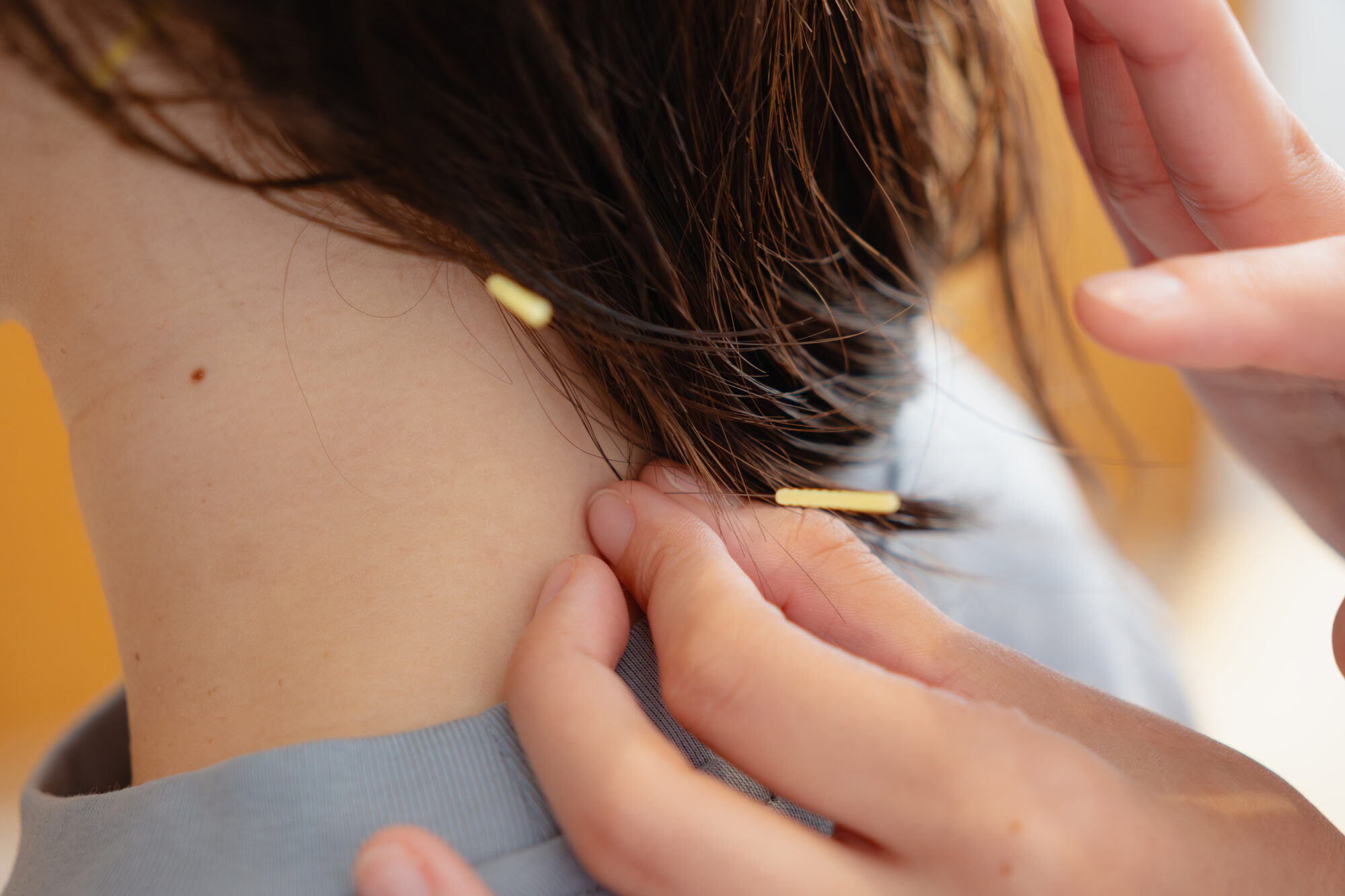 左肩から手の重だるさ 天神エリアの整体院で神経圧迫を改善した症例