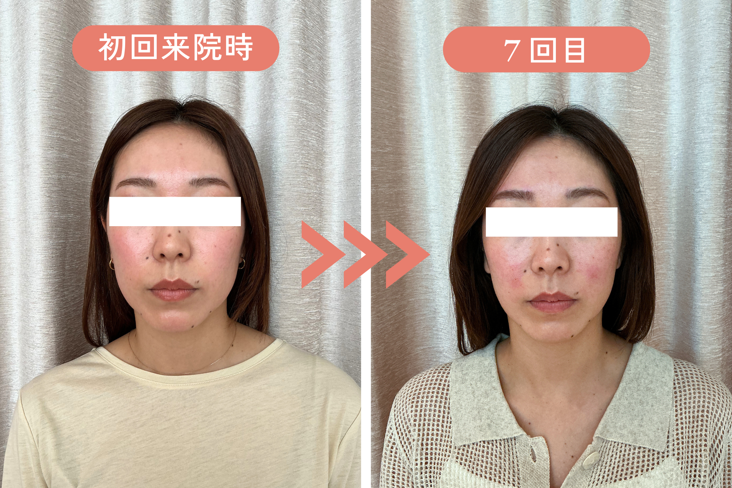 T様 施術前と施術後の比較。表情筋の柔軟性が整い、輪郭・血色の状態が変化している様子
